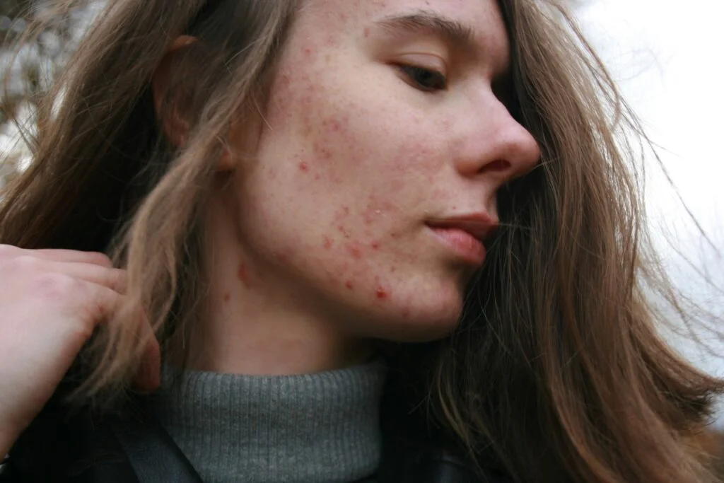 Woman with acne breakouts on her cheek looking to the side