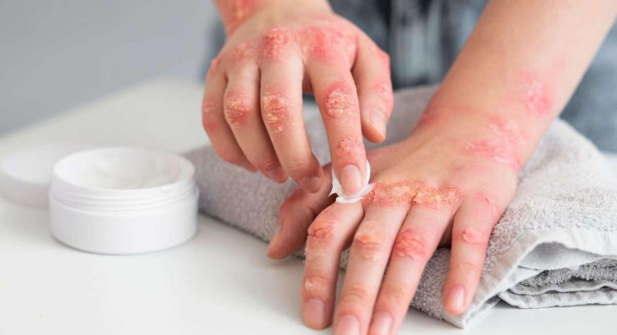 CBD Oil For Psoriasis: What Does The Research Say?